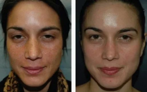 Before &After